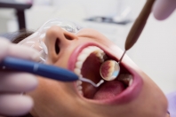 Nowoczese metody endodoncji